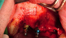 Colocamos los implantes y más material de injerto